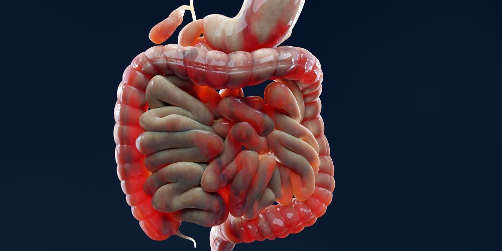 Έξαρση Νόσου Crohn: Ποια Τρόφιμα να καταναλώσεις